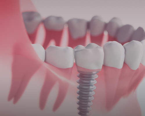 Dental implants 2