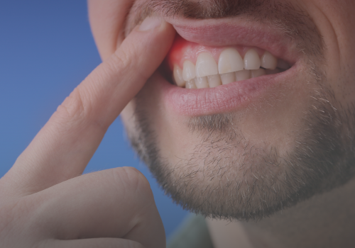 Laser gum beautification 2