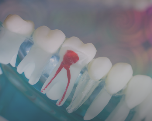 Root canal