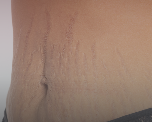 Stretch mark 2
