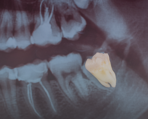 Wisdom tooth extraction 2